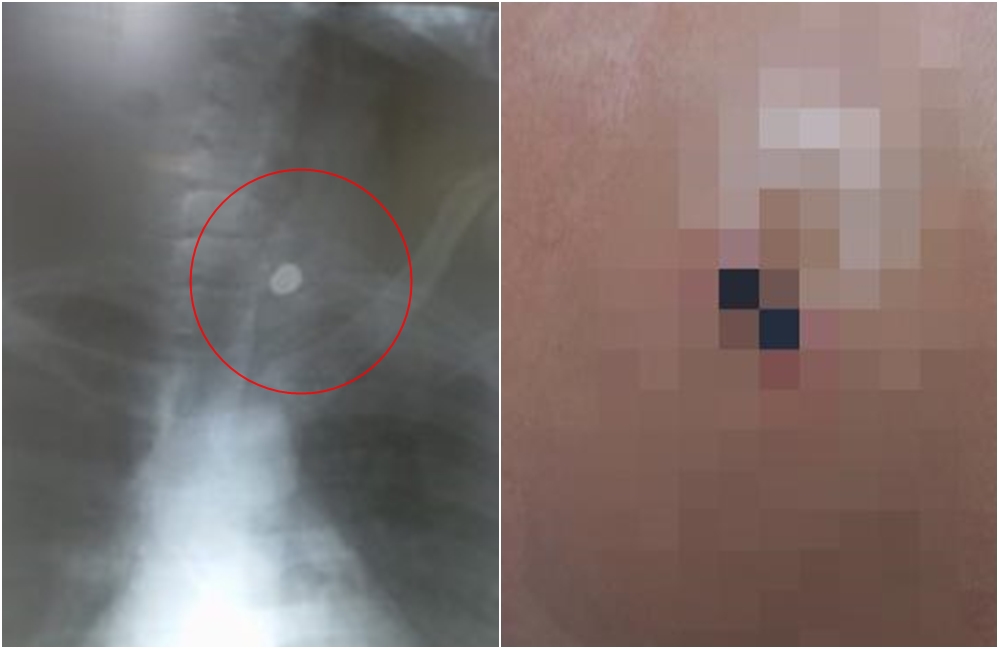 Jovem baleado após blitz na BA-409 contesta versão policial e diz que não estava armado